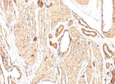 Immunohistological Detection of alpha-Smooth Muscle Actin in Paraffin Embedded Human Leiomyosarcoma