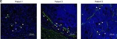 Immunohistological Staining of alpha-Smooth Muscle Actin in Paraffin Embedded Cancer Tissues
