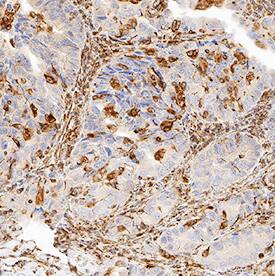 20S Proteasome antibody in Human Lung Cancer Tissue by Immunohistochemistry (IHC-P).