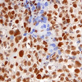 53BP1 antibody in Human Cervical Cancer Tissue by Immunohistochemistry (IHC-P).