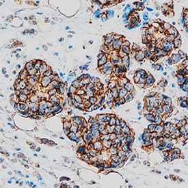 AG-2/AGR2 antibody in Human Breast Cancer Tissue by Immunohistochemistry (IHC-P).