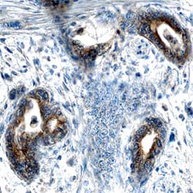 AHR antibody in Human Pancreatic Cancer Tissue by Immunohistochemistry (IHC-P).