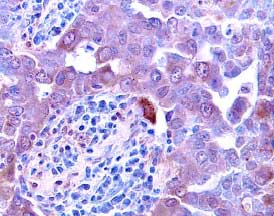 Activin A antibody in Human Breast Cancer Tissue by Immunohistochemistry (IHC-P).