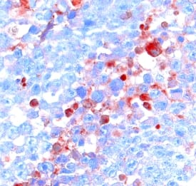 Activin RIA/ALK-2 antibody in Human Astrocytoma by Immunohistochemistry (IHC-P).