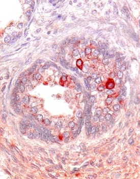 Activin RIIA antibody in Human Prostate Cancer Tissue by Immunohistochemistry (IHC-P).