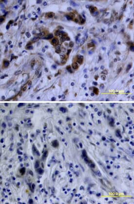 Akt antibody in Human Breast Cancer Tissue by Immunohistochemistry (IHC-P).