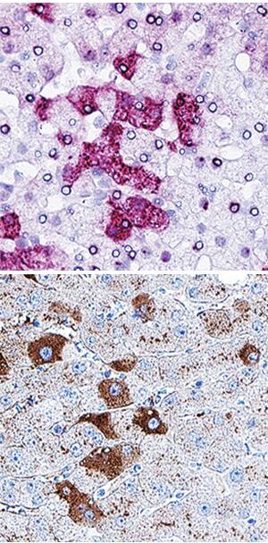 Serum Albumin in Human Liver Using Dual RNAscope<sup>®</sup>ISH and IHC. Serum Albumin antibody in Human Liver Using Dual RNAscope®ISH and IHC.