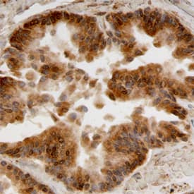 Aldehyde Dehydrogenase 1-A1/ALDH1A1 antibody in Human Prostate Cancer Tissue by Immunohistochemistry (IHC-P).