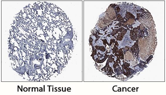 Aldehyde Dehydrogenase 3-A1/ALDH3A1 antibody in Human Normal Lung and Lung Cancer Tissue by Immunohistochemistry (IHC-P).