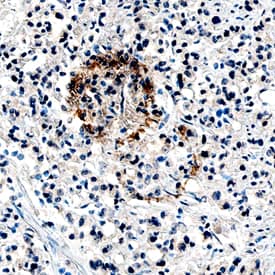 Angiopoietin-1 antibody in Human Prostate Cancer Tissue by Immunohistochemistry (IHC-P).