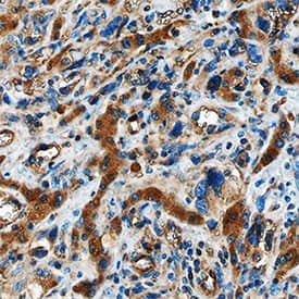 Angiopoietin-2 antibody in Human Liver Cancer Tissue by Immunohistochemistry (IHC-P).