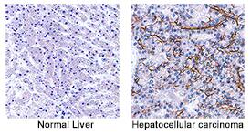 Angiopoietin-2 antibody in Human Hepatocellular Carcinoma Tissue by Immunohistochemistry (IHC-P).