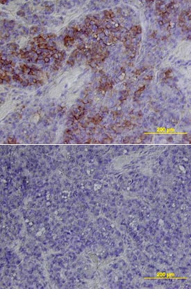B7-H3 in Human Melanoma. B7-H3 antibody in Human Melanoma by Immunohistochemistry (IHC-P).