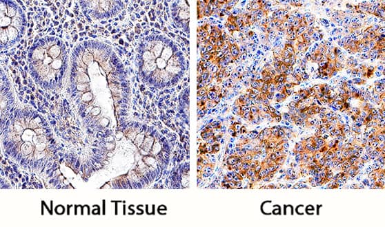 PD-L1/B7-H1 antibody in Human Colon and Colon Cancer Tissue by Immunohistochemistry (IHC-P).