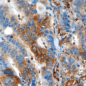 PD-L1/B7-H1 antibody in Human Colon Cancer by Immunohistochemistry (IHC-P).