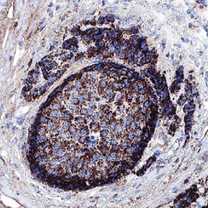 B7-H4 antibody in Human Breast Cancer Tissue by Immunohistochemistry (IHC-P).