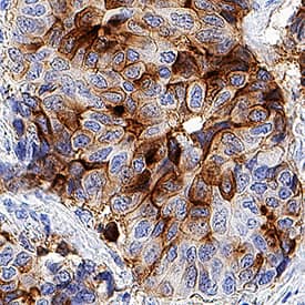 B7-H4 antibody in Human Breast Cancer Tissue by Immunohistochemistry (IHC-P).