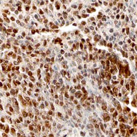 BACH1 antibody in Human Lung Cancer Tissue by Immunohistochemistry (IHC-P).