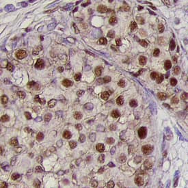 BMI-1 antibody in Human Breast Cancer Tissue by Immunohistochemistry (IHC-P).