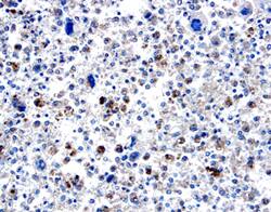 BMP-8 antibody in Human Osteo-sarcoma by Immunohistochemistry (IHC-P).