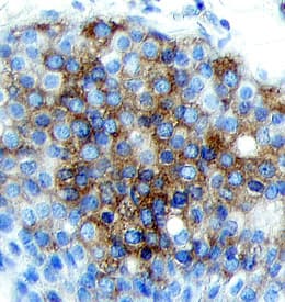 BRCA1 antibody in Human Breast Cancer Tissue by Immunohistochemistry (IHC-P).