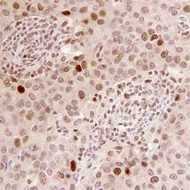 BRIP1/FANCJ antibody in Human Breast Cancer Tissue by Immunohistochemistry (IHC-P).