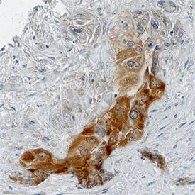 BTF3 antibody in Human Pancreas Cancer Tissue by Immunohistochemistry (IHC-P).