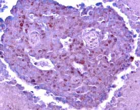 Bcl-2 antibody in Human Breast Cancer Tissue by Immunohistochemistry (IHC-P).