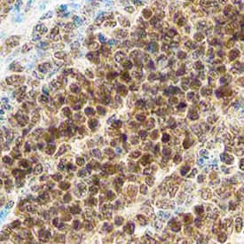 Bcl-2 antibody in Human Lymphoma by Immunohistochemistry (IHC-P).