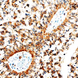Betacellulin/BTC antibody in Human Lung Cancer Tissue by Immunohistochemistry (IHC-P).