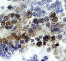 Brk antibody in Human Lymphoma by Immunohistochemistry (IHC-P).