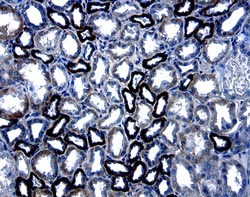 C-Reactive Protein/CRP antibody in Human Kidney Cancer Tissue by Immunohistochemistry (IHC-P).