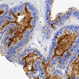 CA125/MUC16 antibody in Human Ovarian Cancer Tissue by Immunohistochemistry (IHC-P).