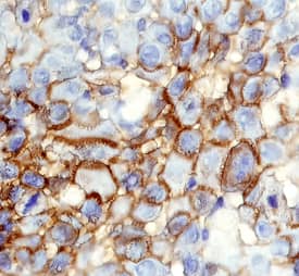CD109 antibody in Human Squamous Cell Carcinoma by Immunohistochemistry (IHC-P).