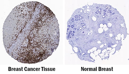 CD15/Lewis X in Human Breast Cancer Tissue. CD15/Lewis X antibody in Human Breast Cancer Tissue by Immunohistochemistry (IHC-P).