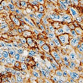 CD44 antibody in Human Lymphoma by Immunohistochemistry (IHC-P).
