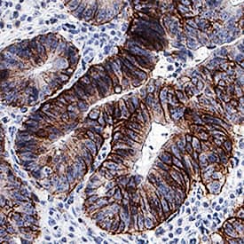 CD44 antibody in Human Colon Adenocarcinoma Tissue by Immunohistochemistry (IHC-P).