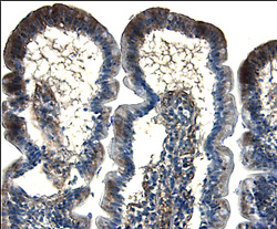 CD55/DAF antibody in Human Colon Cancer Tissue by Immunohistochemistry (IHC-P).