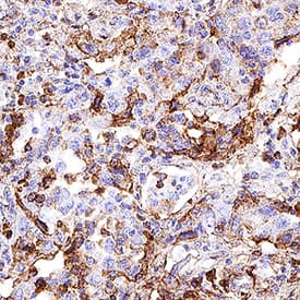 CD63 antibody in Human Lung Cancer Tissue by Immunohistochemistry (IHC-P).