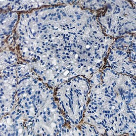 CD90/Thy1 antibody in Human Prostate Cancer Tissue by Immunohistochemistry (IHC-P).