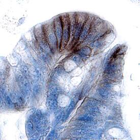 CDCP1 antibody in Human Colon Cancer Tissue by Immunohistochemistry (IHC-P).