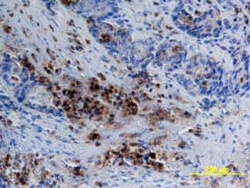 CEACAM-1/CD66a antibody in Human Colon Cancer Tissue by Immunohistochemistry (IHC-P).