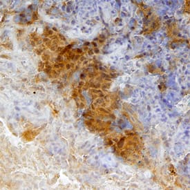 CEACAM-4 antibody in Human Lung Cancer Tissue by Immunohistochemistry (IHC-P).