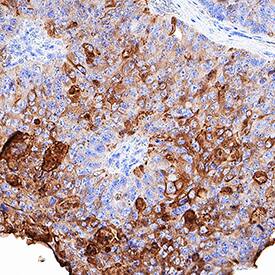 CEACAM-7 antibody in Human Colon Cancer Tissue by Immunohistochemistry (IHC-P).