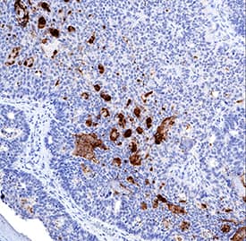 CEACAM-7 antibody in Human Colon Cancer Tissue by Immunohistochemistry (IHC-P).