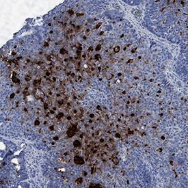 CEACAM-7 antibody in Human Colon Cancer Tissue by Immunohistochemistry (IHC-P).