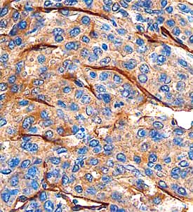 CLEC14A antibody in Human Breast Cancer Tissue by Immunohistochemistry (IHC-P).