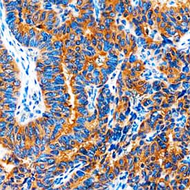 COX-2 antibody in Human Breast Cancer Tissue by Immunohistochemistry (IHC-P).