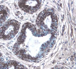 CTGF/CCN2 antibody in Human Breast Cancer Tissue by Immunohistochemistry (IHC-P).