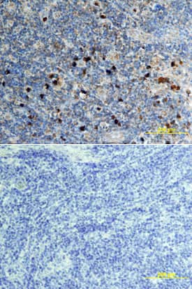 CXCL16 antibody in Human Lymphoma by Immunohistochemistry (IHC-P).